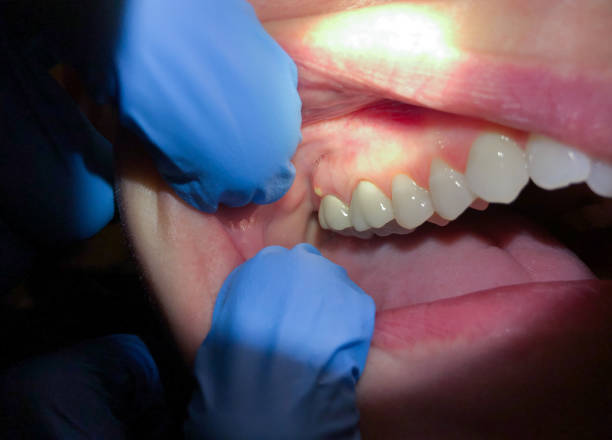 Best Emergency Treatment for Toothache in Colonial Beach, VA